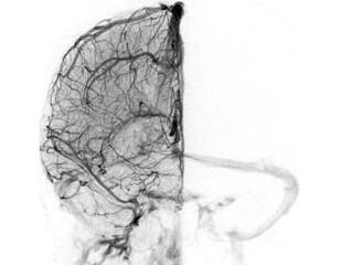 A detailed cerebral angiogram showcasing intricate blood vessels in the brain. The image highlights...