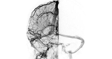 Obraz premium A detailed cerebral angiogram showcasing intricate blood vessels in the brain. The image highlights the vascular structure, providing insights into blood flow and potential abnormalities.