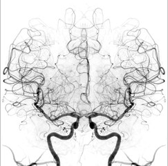 A detailed cerebral angiogram showcasing intricate blood vessels in the brain. The image highlights the vascular structure, providing insights into blood flow and potential abnormalities.