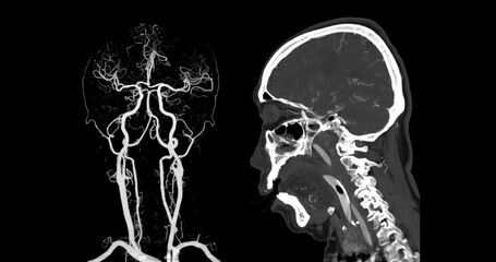 The CT Angiography (CTA) scan of the brain and neck, showcasing the intricate vascular network in vivid detail. It highlights major blood vessels, aiding in diagnosing cerebrovascular conditions.