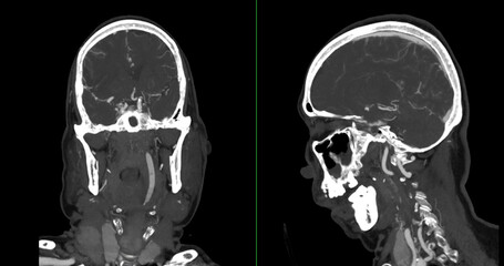 The CT Angiography (CTA) scan of the brain and neck, showcasing the intricate vascular network in vivid detail. It highlights major blood vessels, aiding in diagnosing cerebrovascular conditions.