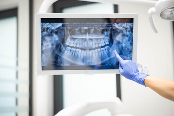 A dental professional wearing gloves points to a dental X-ray displayed on a monitor, highlighting details of a patient's teeth for review or diagnosis.