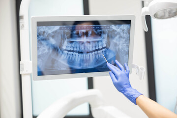 A dentist in blue gloves uses a dental tool to point at a specific area on a digital dental X-ray,...