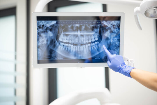 A dental professional wearing gloves points to a dental X-ray displayed on a monitor, highlighting details of a patient's teeth for review or diagnosis. - Powered by Adobe
