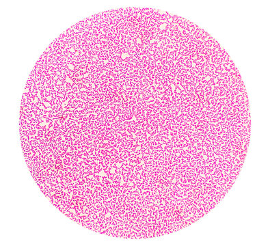 Salmonellosis. Microscopic view of gram stained slide from blood agar salmonella colonies, show Salmonella Typhi (S. Typhi) bacteria. typhoid fever.