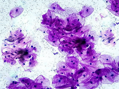 Light micrograph of a vaginal smear showing adenocarcinoma cells (center)and bacteria cells. Vaginal cancer. Inflammatory smear with HPV related changes. Cervical cancer. SCC