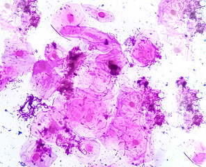 Naklejka premium High vaginal swab gram stained microscopic show inflamatory epithelal cell and streptococcus Spp. diagnosis of Bacterial vaginosis (BV)