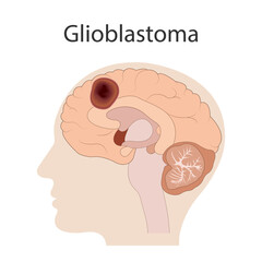 Section of the brain with glioblastoma tumor, Brain cancer concept.