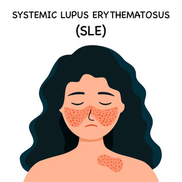 Systemic lupus erythematosus. Girl with the typical butterfly rash in lupus. SLE. skin disease.