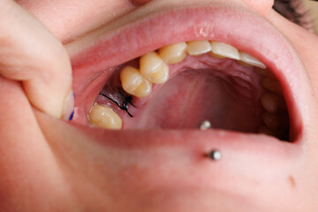 Primer plano de boca abierta con punto de sutura dental