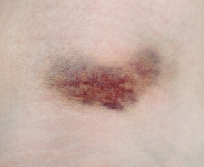 Close up purple bruise on skin. Bruise from impact. Bruising and hematoma on human body