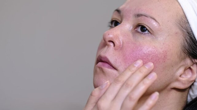 Detailed view of uneven skin with acne and pimples. Facial pores, blemishes, and natural texture. Concept of skin issues, treatments, and care for a healthy appearance.