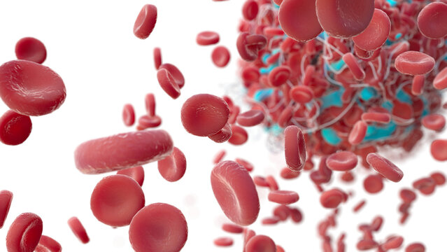 Blood clot, illustration