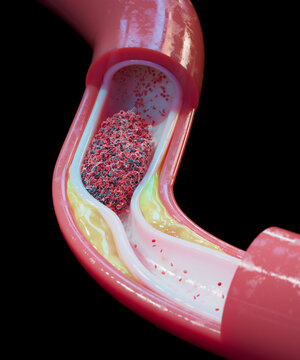 Atherosclerosis and blood clot in human blood vessel, illustration