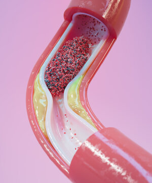 Atherosclerosis and blood clot in human blood vessel, illustration