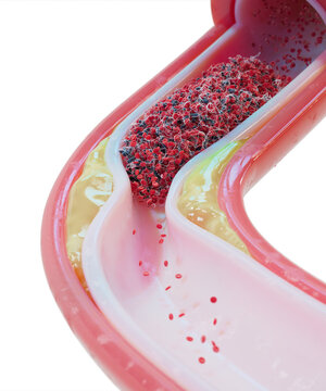 Atherosclerosis and blood clot in human blood vessel, illustration