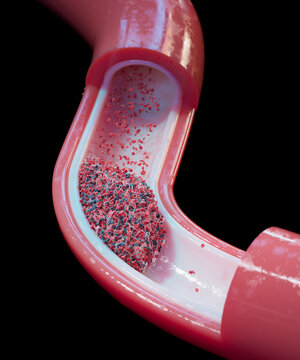 Blood clot in blood vessel, Illustration