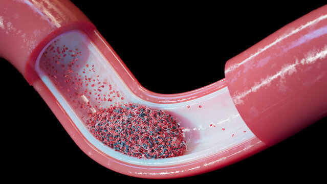 Blood clot in blood vessel, Illustration