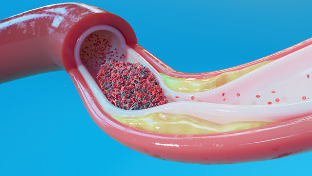 Atherosclerosis and blood clot in human blood vessel, illustration