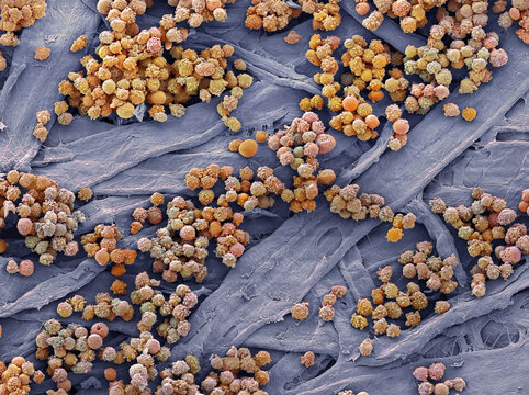 Leukaemia, SEM