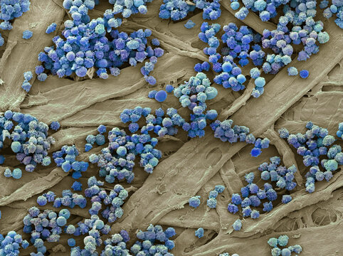 Leukaemia, SEM