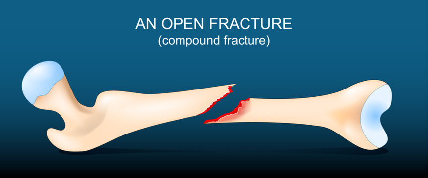 Compound fracture of human Femur bone.