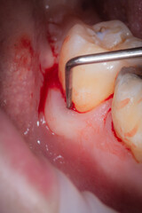 Periodontal probing lower molar