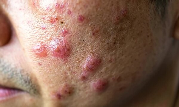 Close-up of Adult Male Face with Acne Problems