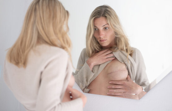 Woman examines herself in the mirror, showing the early stages of breast reconstruction after a mastectomy due to breast cancer