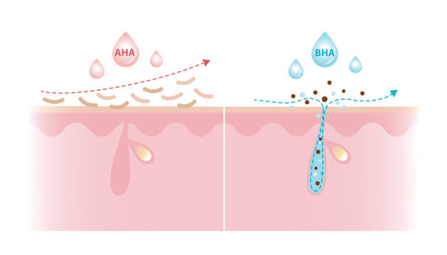 Alpha Hydroxy Acids and Beta Hydroxy Acids characteristics vector illustration on white background. AHA exfoliate the surface skin and water soluble. BHA penetrate deep into the pore and oil soluble.