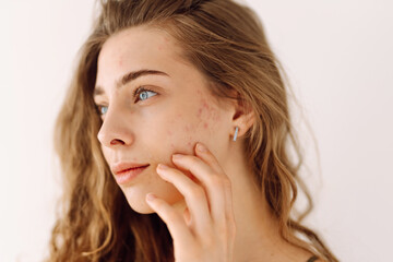 Portrait of a young girl with problem skin. Pimples, acne, pores, scars. Natural skin. Problem skin...
