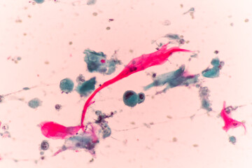View in microscopic of abnormal cervical or vagina cells.Squamous epithelium cells.Squamous cell carcinoma.Cytology and pathology laboratory department.Cancer cells.Malignant human lung tumor cells.