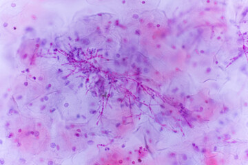 View in microscopic of Candidiasis, fungal infection (Yeast and Pseudohyphae form) in pap smear...