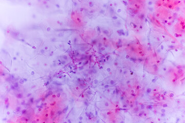 View in microscopic of Candidiasis, fungal infection (Yeast and Pseudohyphae form) in pap smear...