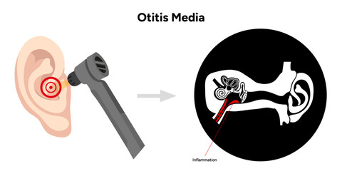 Otitis media inflammation anatomy human ear pain disease medical infographic and check up in doctor appointment 