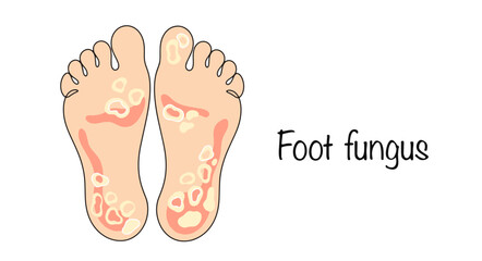 Foot fungus