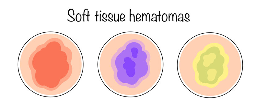 Soft tissue hematomas
