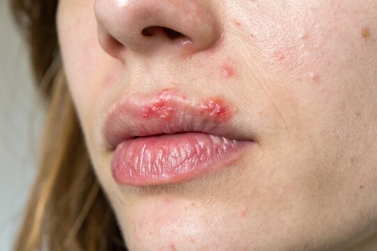 Close-Up of Cold Sore on Lip with Redness and Blister, Dermatology