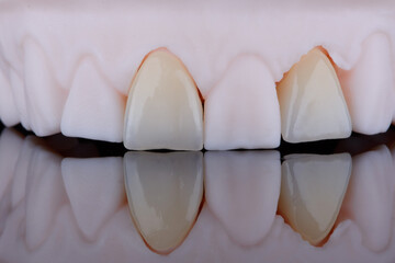 High-quality naturally dental single crowns made of zirconium for fixation to the frontal teeth of upper jaw. © gorynvd