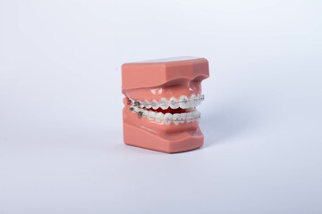 Model of jaw with braces isolated on white background