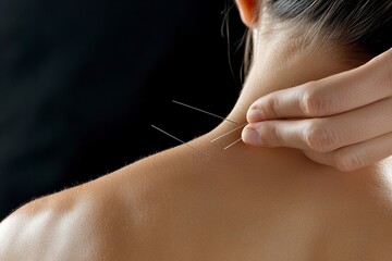 Close-up of the back neck and shoulder area, an acupuncturist is using several thin metal needles to treat for pain relief on her upper body. 