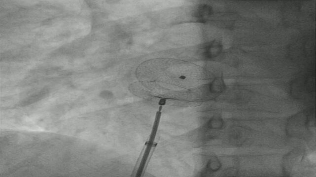  X-Ray Imaging of Atrial Septal Occluder Device Placement in a Patient with Atrial Septal Defect (ASD) During Closure Procedure