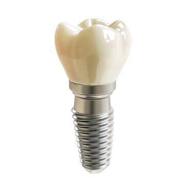 recommend clip art: Dental implant model of molar tooth clip art