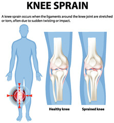 Understanding Knee Sprain and Ligament Injury