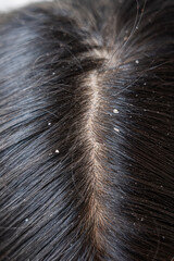 Close up of black hair with dandruff.