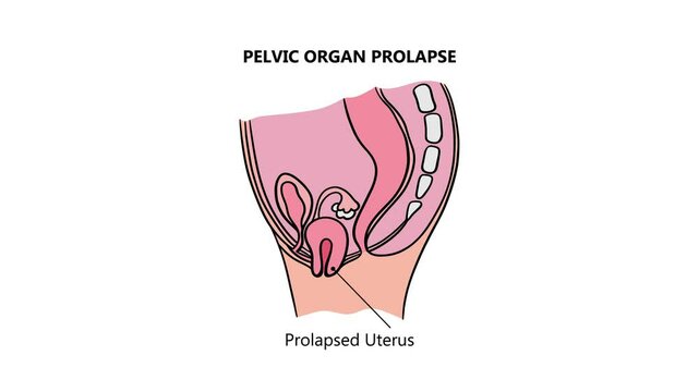 PROLAPSED BLADDER RECTUM UTERUS Of Women Animated Medical Education Scheme For Students Of University 