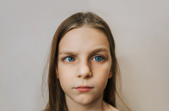 Photograph, close-up portrait of a sick girl, a child with vision problems, strabismus.