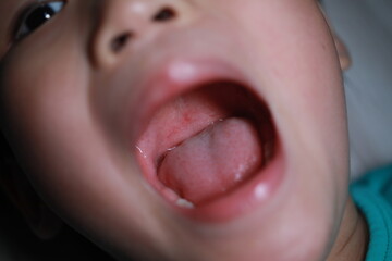 Hand Foot Mouth Disease.