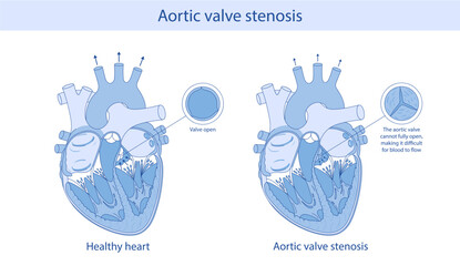 A medical illustration shows the difference between a normal artis valve and a stenotic valve. Illustration in cartoon style