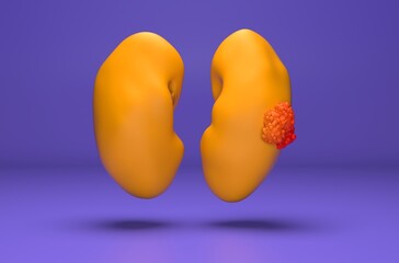 Kidney cancer - isometric view 3d illustration